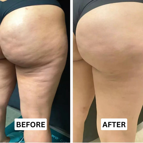 Glossely Cellulite Smoothing Massage Roller